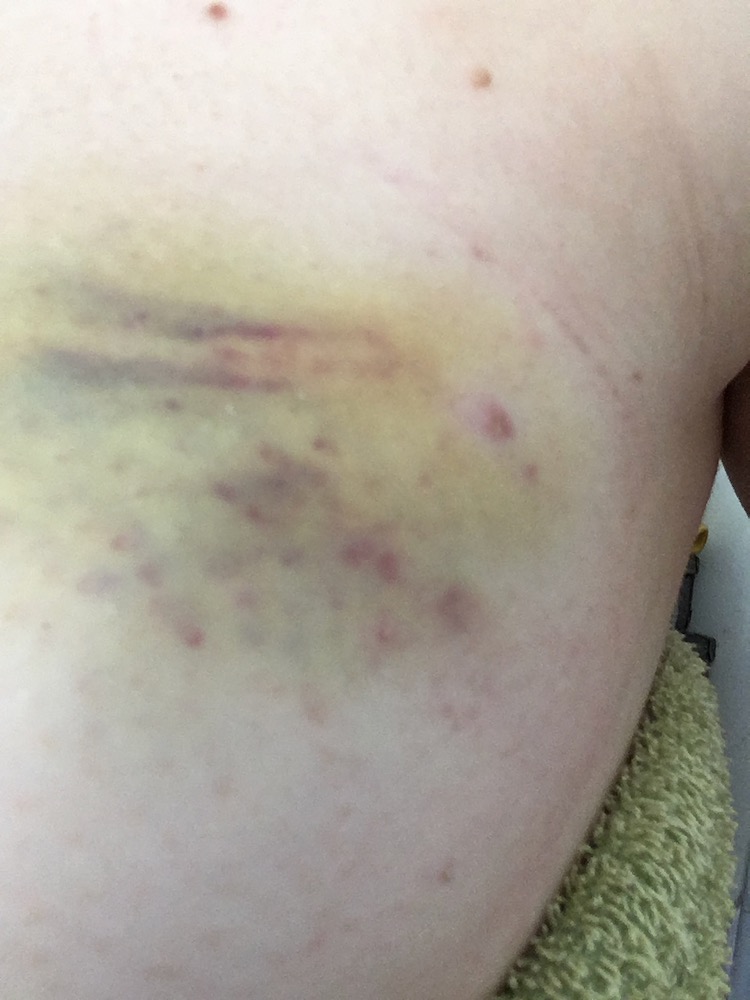 A close up of the side of a breast, showing a deep yellow-purple bruise, and three needle lines disappearing in to the flesh.